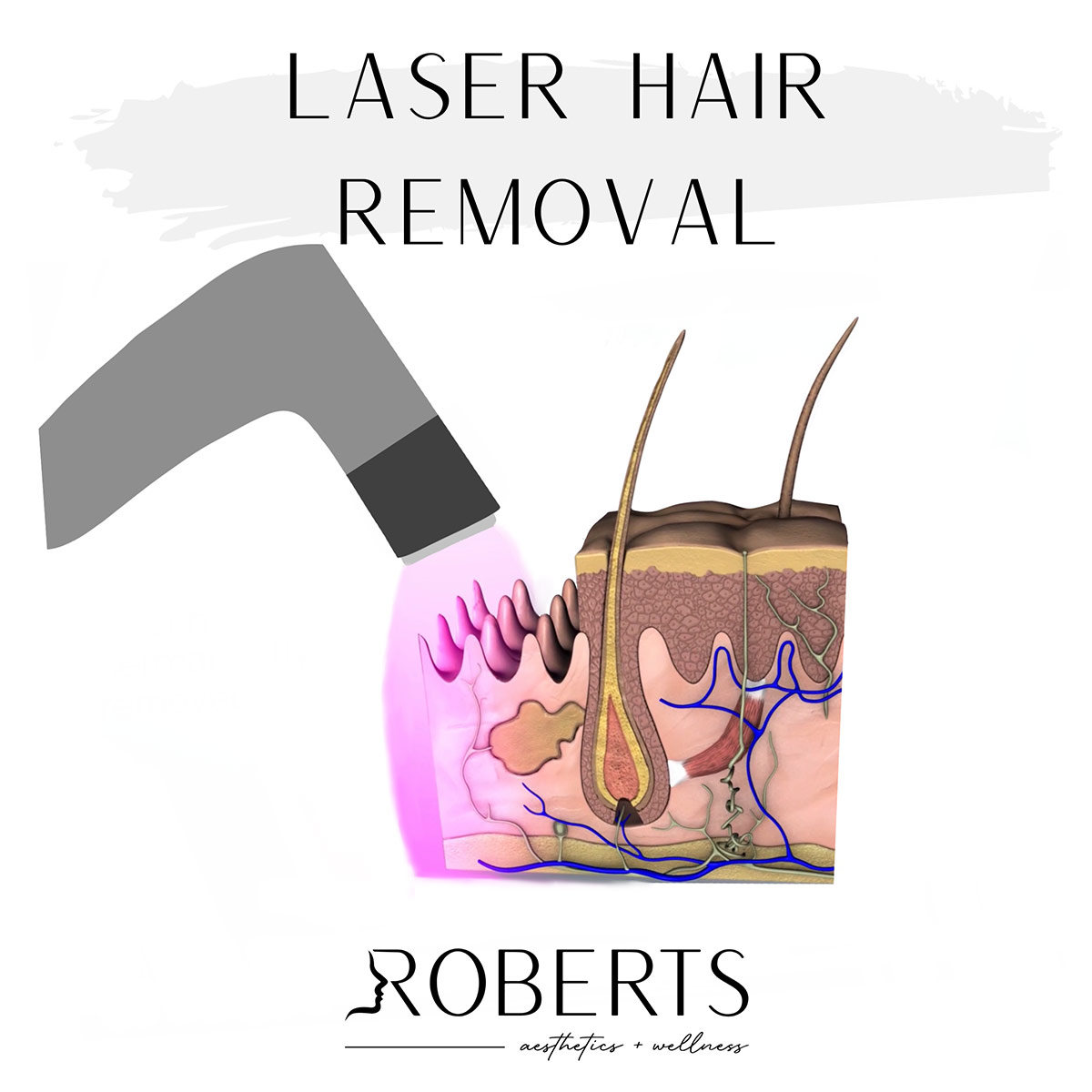 Laser Hair Removal Houma LA Roberts Aesthetics and Wellness