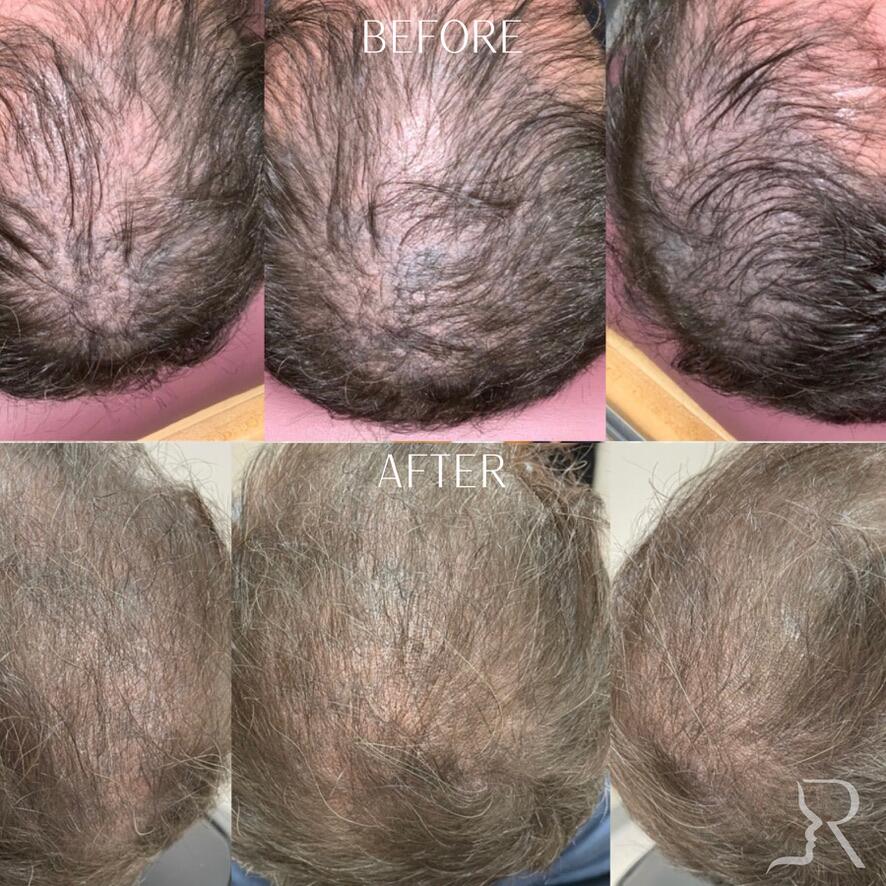 PRF Hair Before & After Image