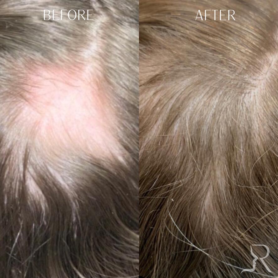 PRF Hair Before & After Image