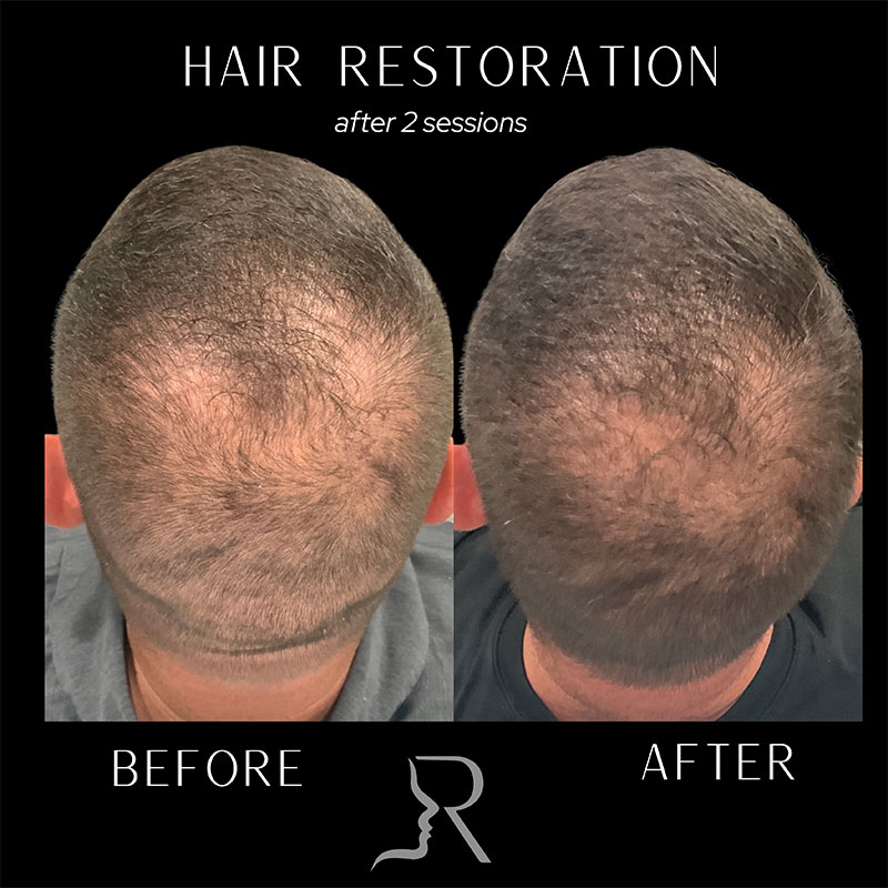 PRF Hair Restoration Before & After Image