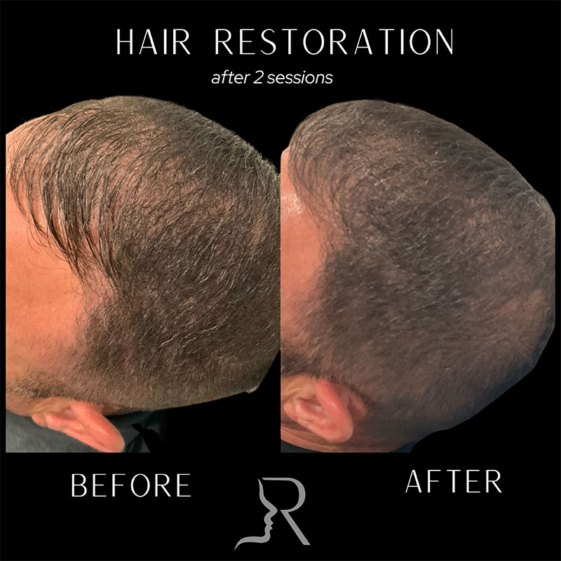 PRF Hair Restoration Before & After Image