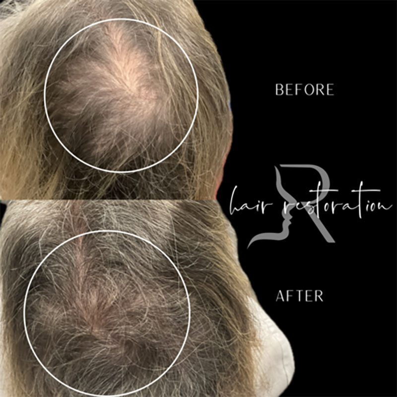 PRF Hair Restoration Before & After Image