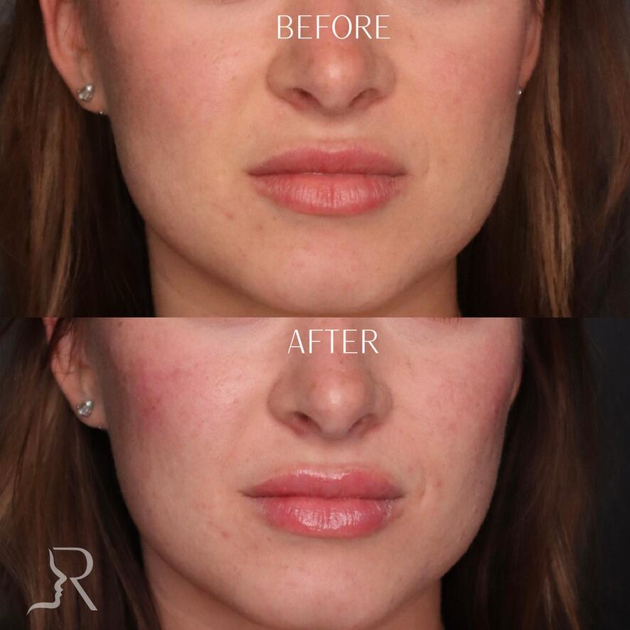 Cheek Fillers Before & After Image