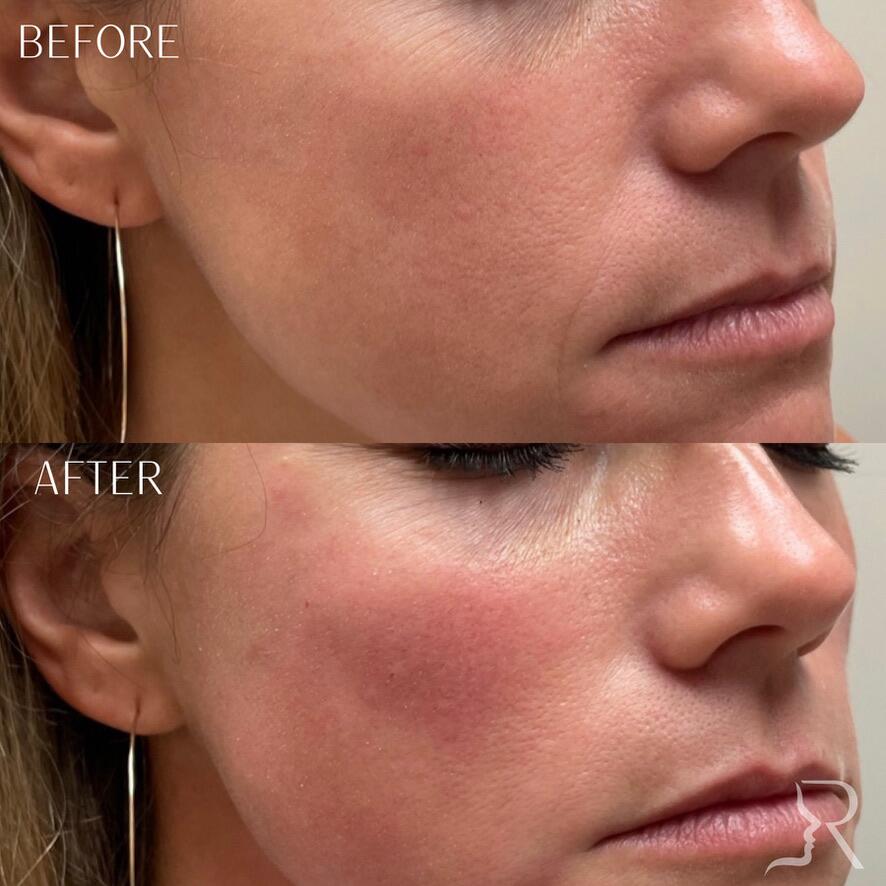 Cheek Fillers Before & After Image