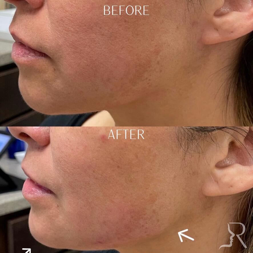 Chin Filler Before & After Image
