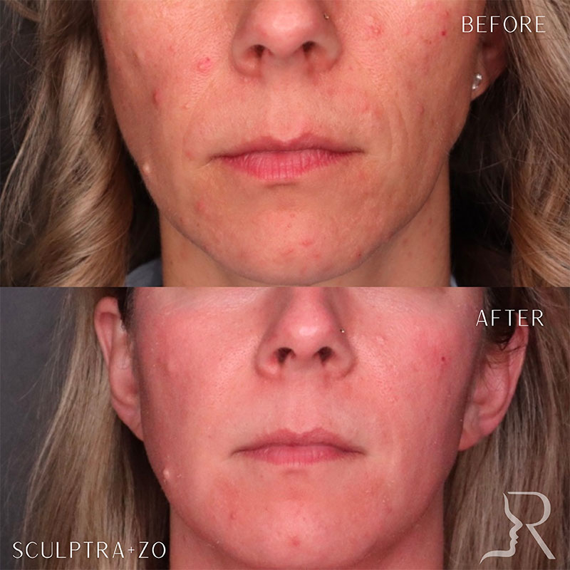 Chin Filler Before & After Image