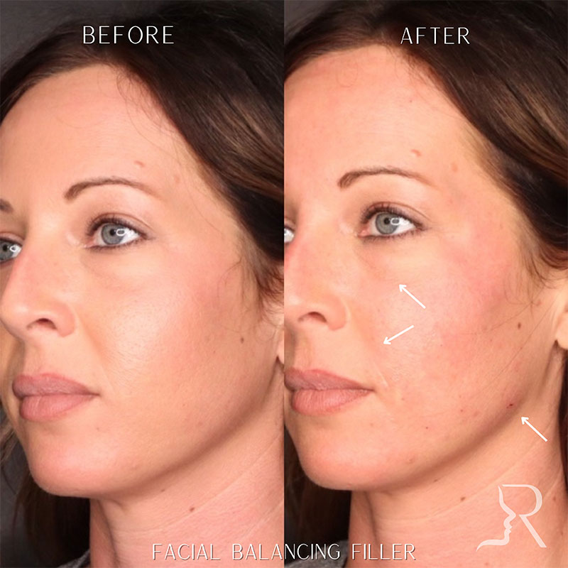 Full Facial Balancing Filler Before & After Image