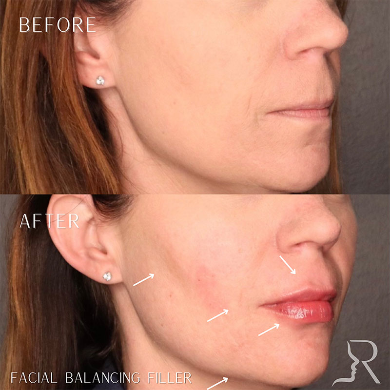 Full Facial Balancing Filler Before & After Image