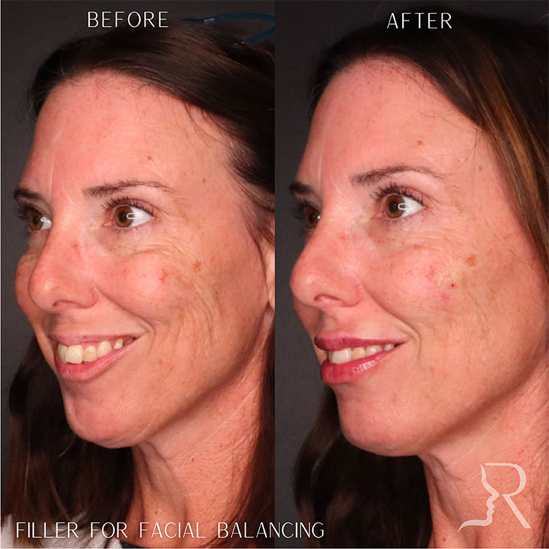 Full Facial Balancing Filler Before & After Image