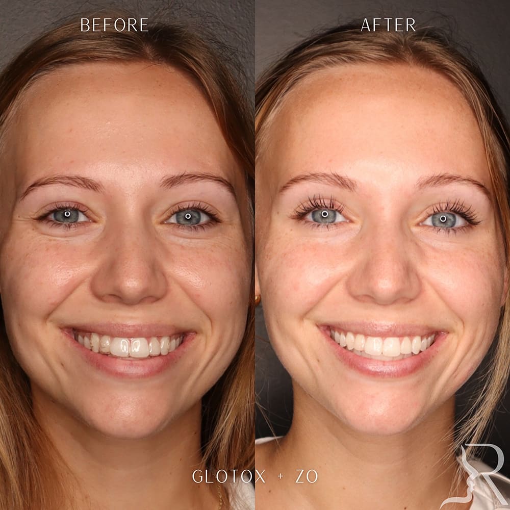 GloTox Before & After Image