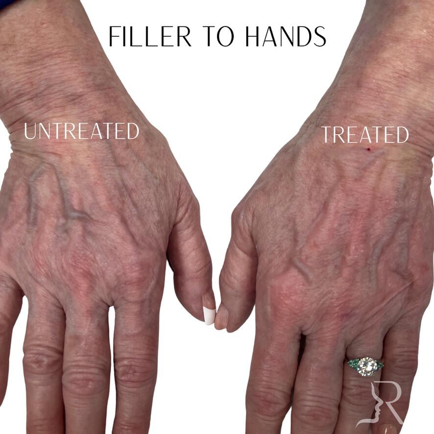 Hand Filler Before & After Image