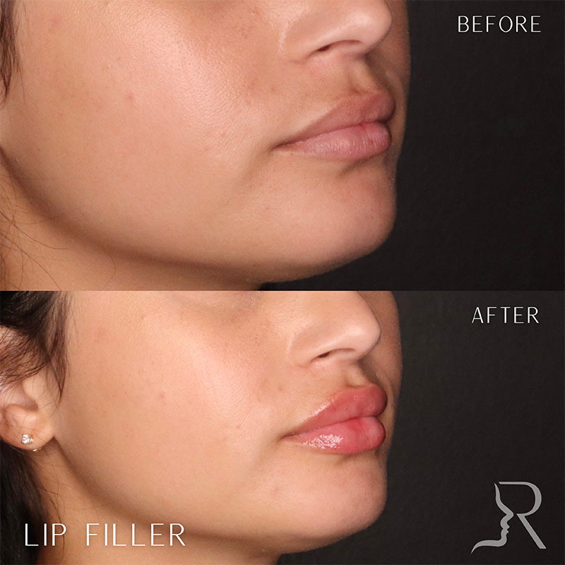 Lip Fillers Before & After Image