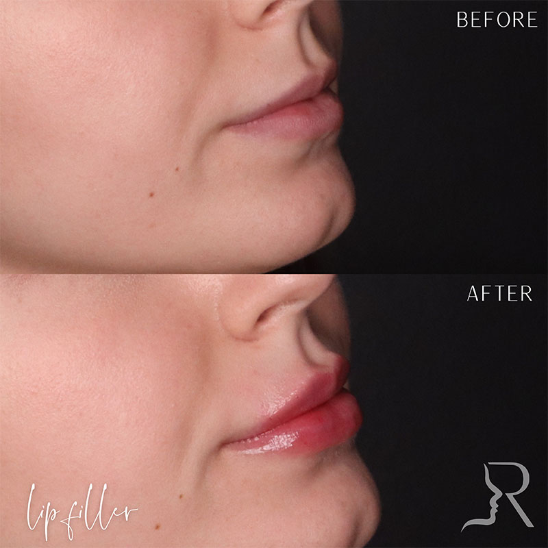 Lip Fillers Before & After Image