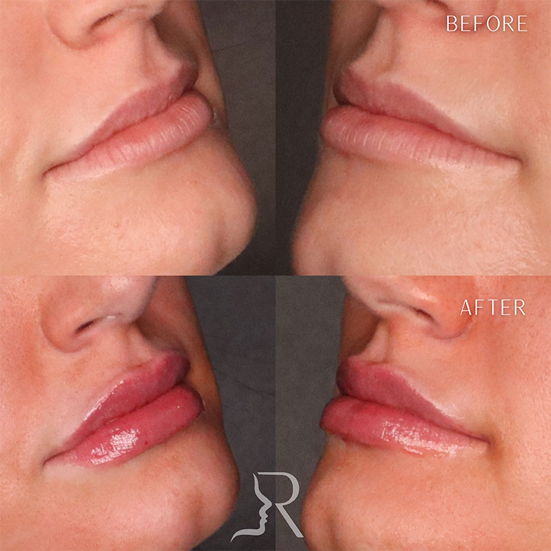 Lip Fillers Before & After Image