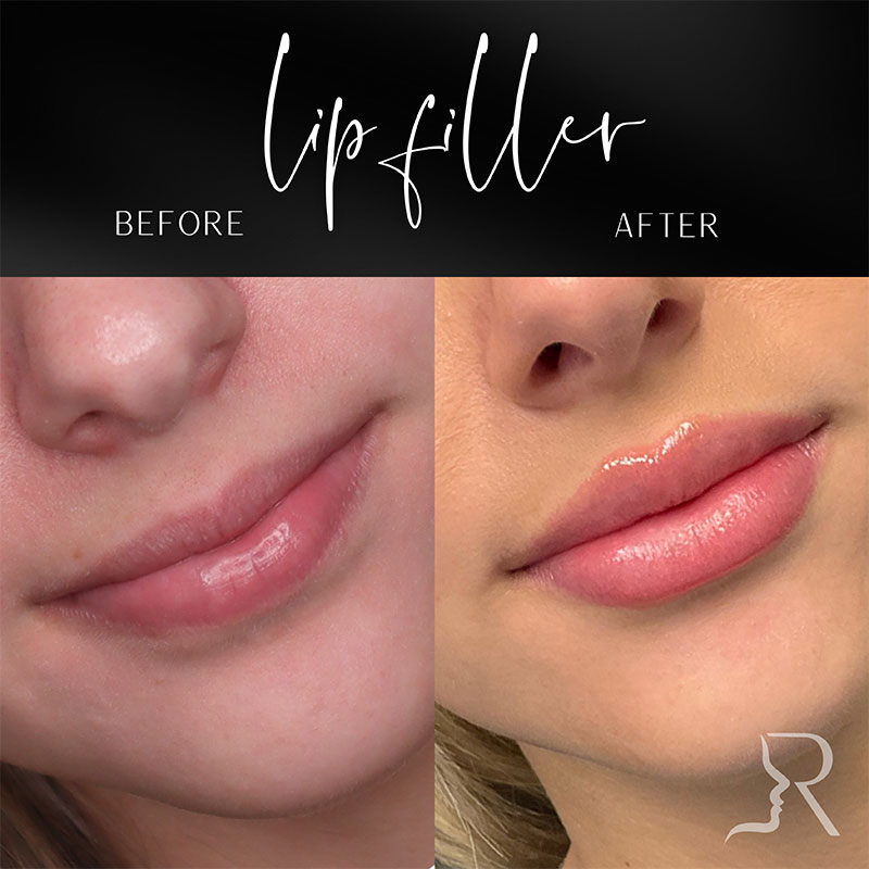 Lip Fillers Before & After Image