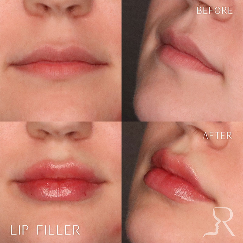 Lip Fillers Before & After Image