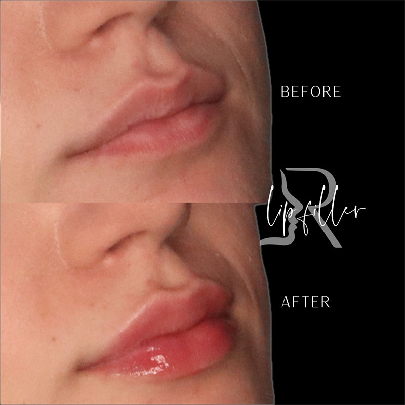 Lip Fillers Before & After Image