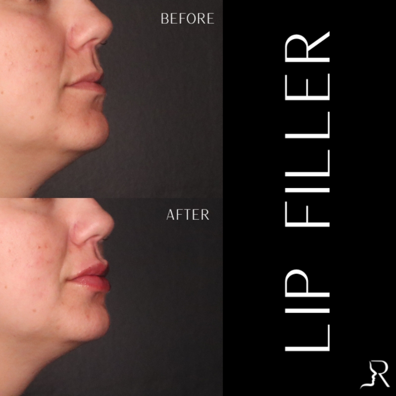 Lip Fillers Before & After Image