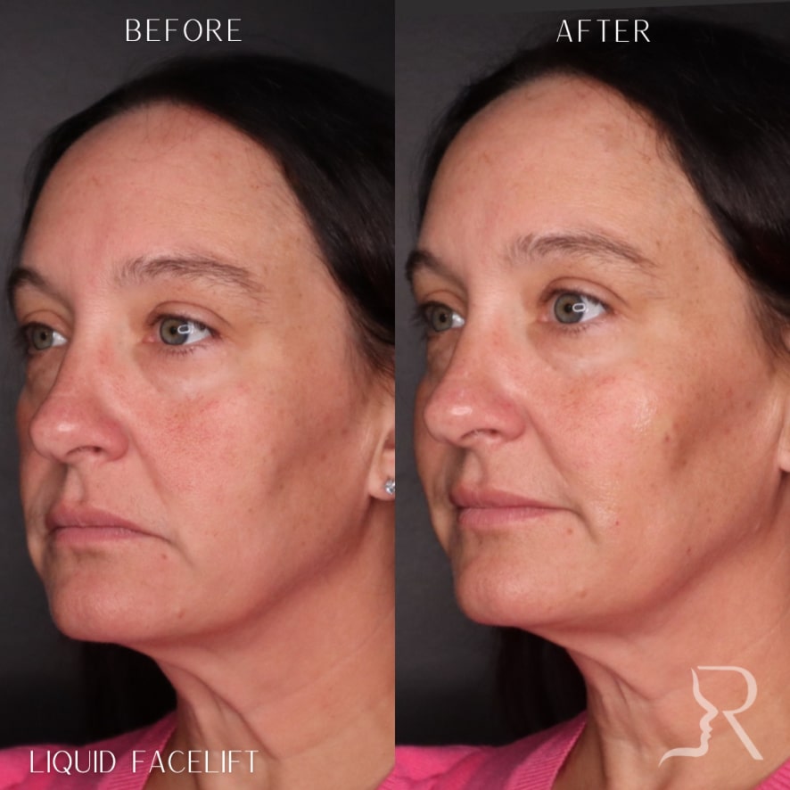 Liquid Facelift Before & After Image