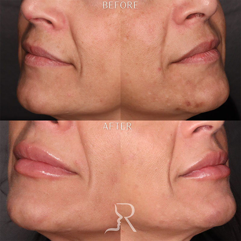 PRF Gel Before & After Image