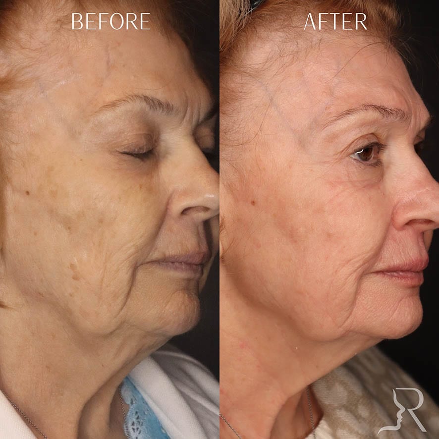 Bright & Tight Before & After Image