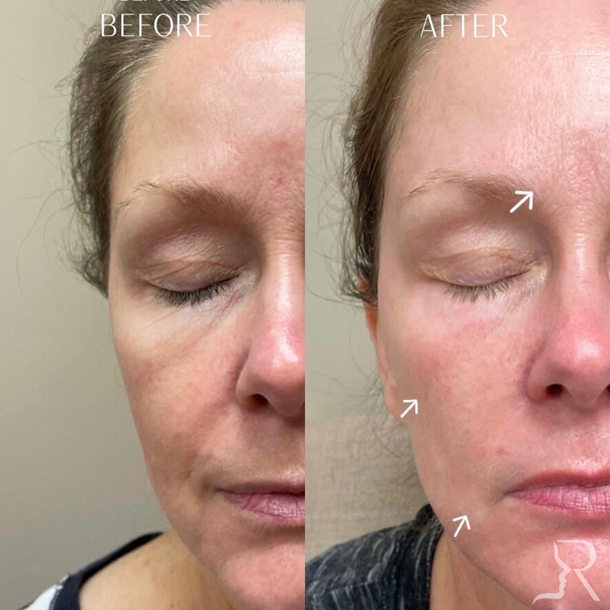 Combo Treatments Before & After Image