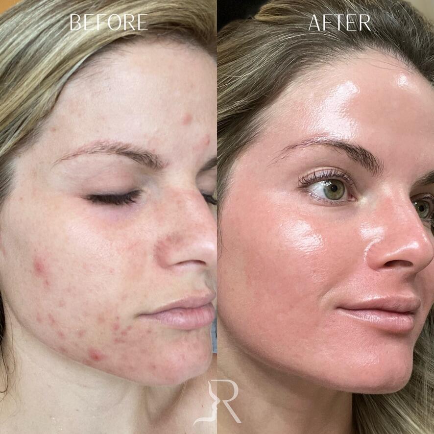 Combo Treatments Before & After Image