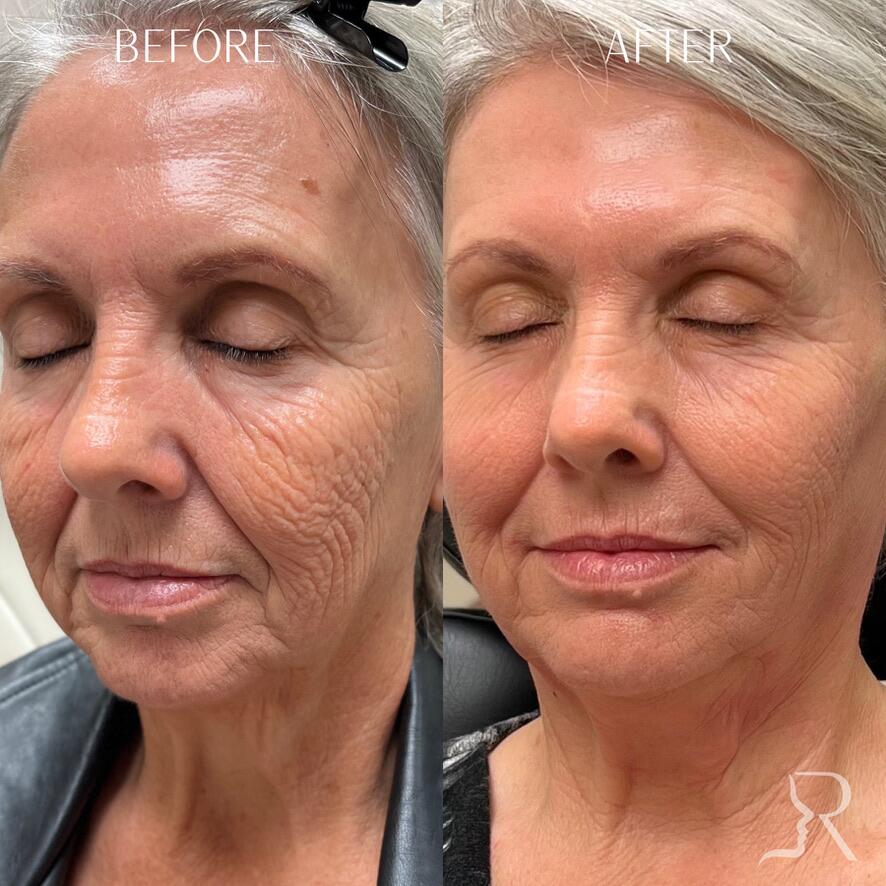 Combination Treatments Before & After Image