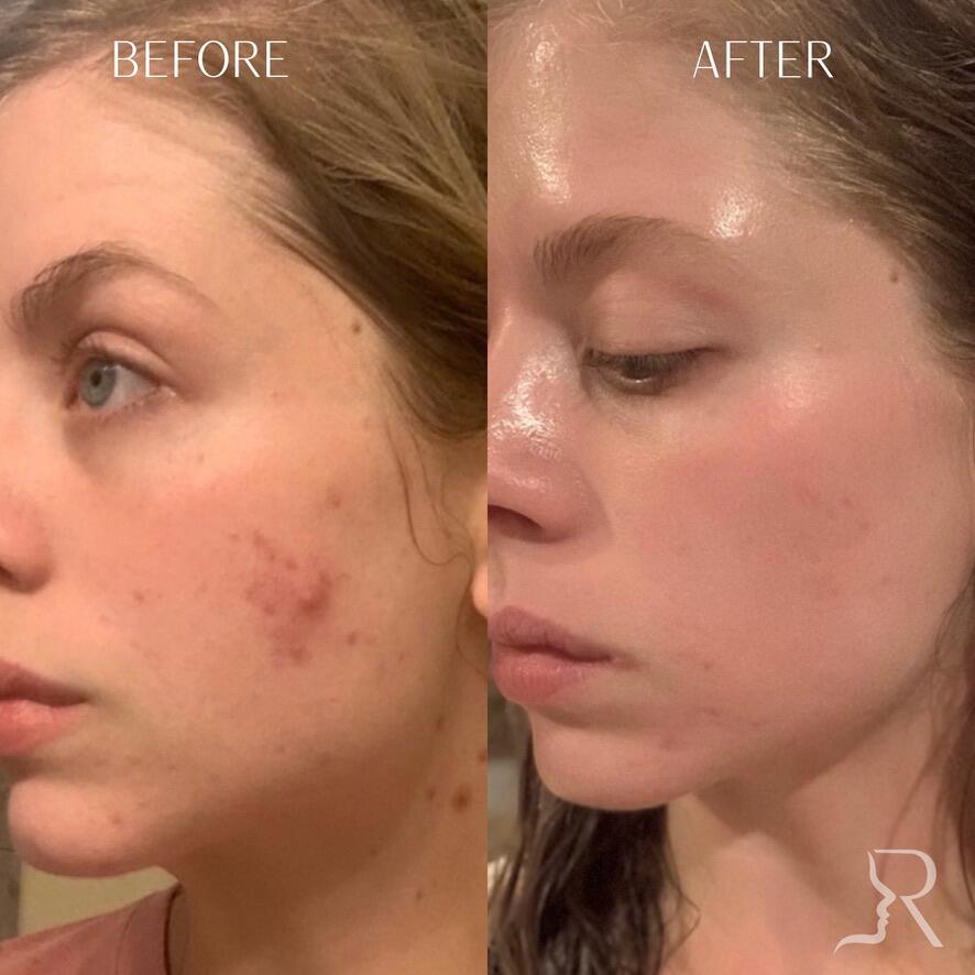 Combination Treatments Before & After Image