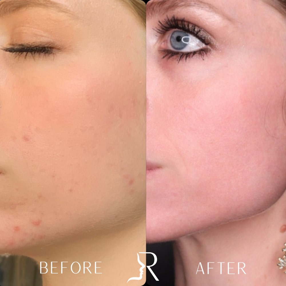 Laser Skin Resurfacing Before & After Image