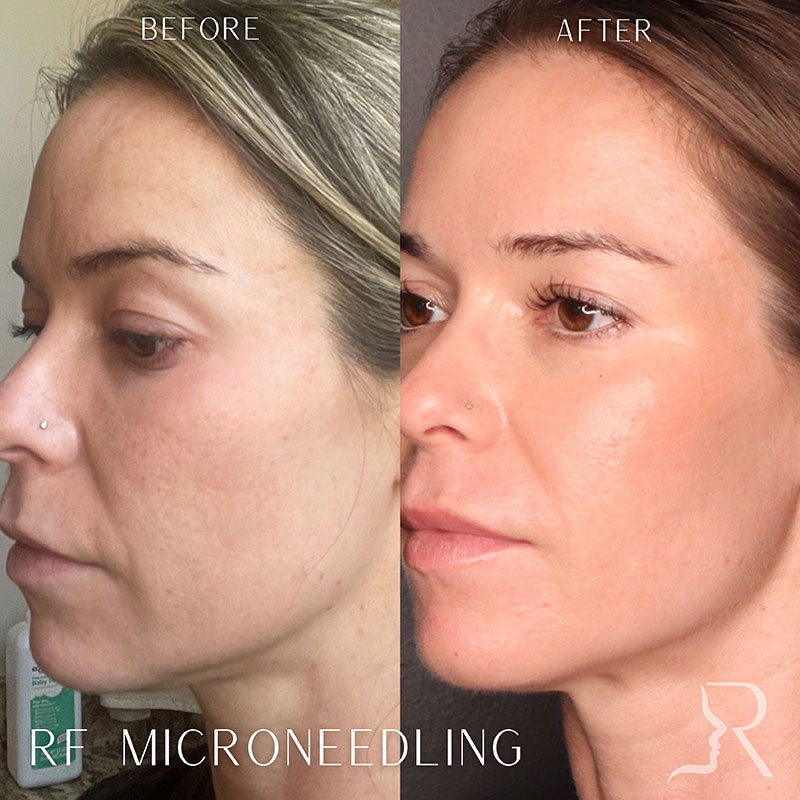 Microneedling Before & After Image