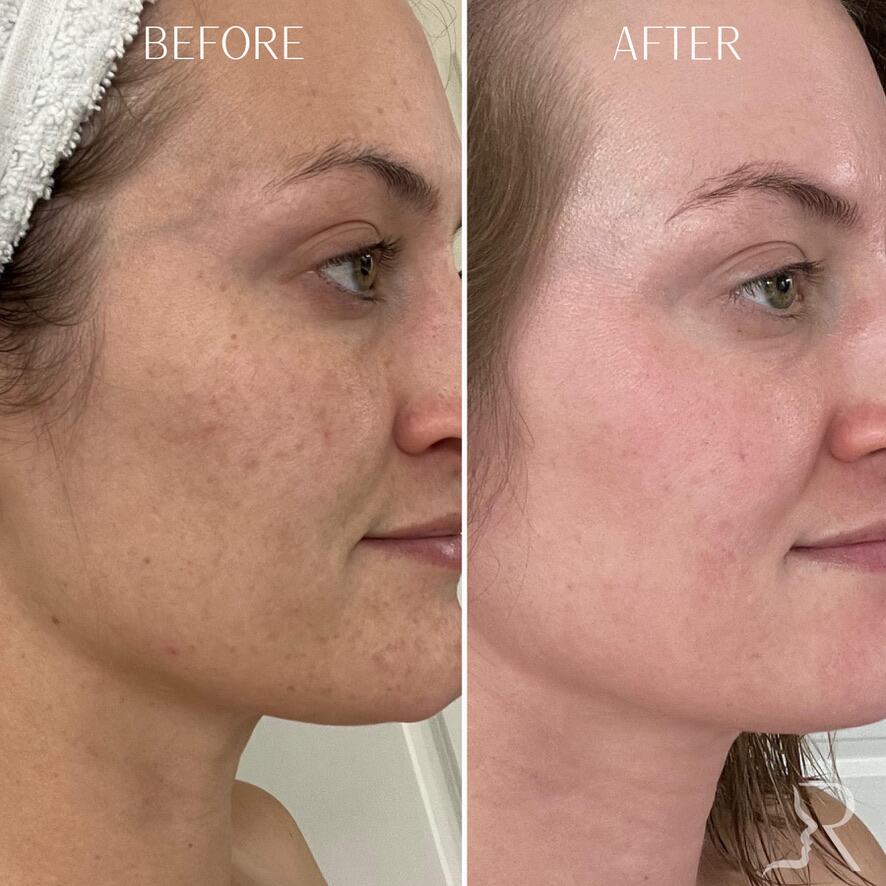 Medical-Grade Skincare Before & After Image