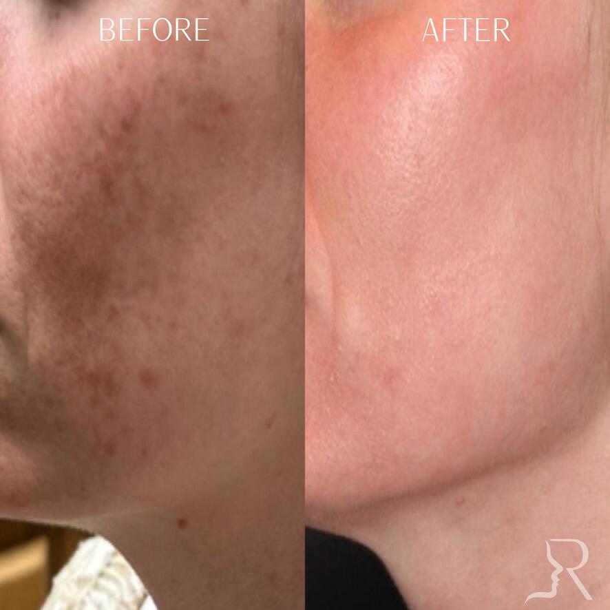 Medical-Grade Skincare Before & After Image