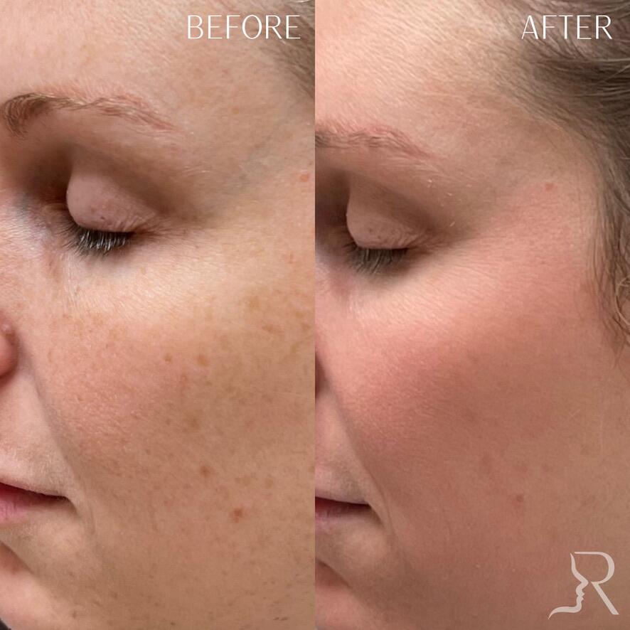 Medical-Grade Skincare Before & After Image