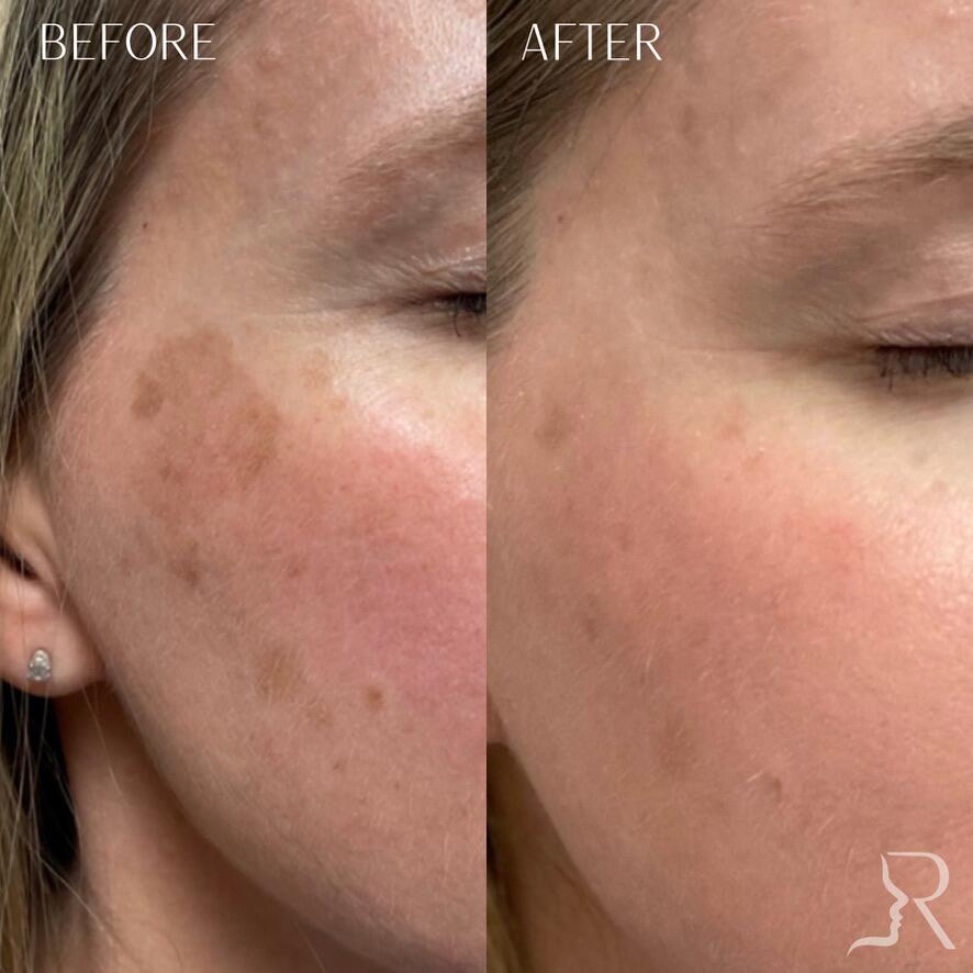 Medical-Grade Skincare Before & After Image