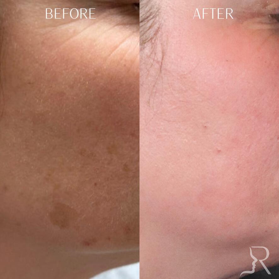 Medical-Grade Skincare Before & After Image