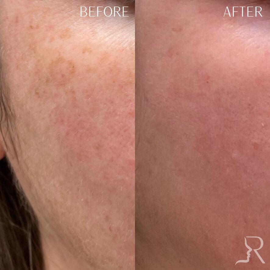 Medical-Grade Skincare Before & After Image