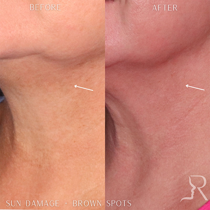 Medical-Grade Skincare Before & After Image