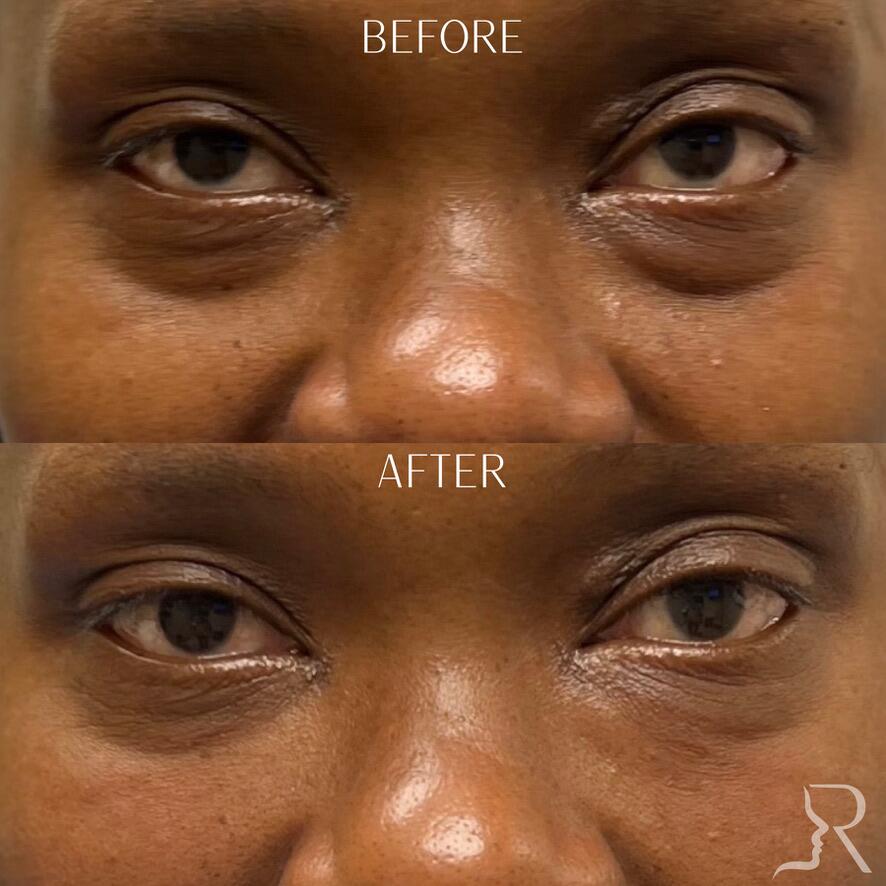PRF Skin Before & After Image