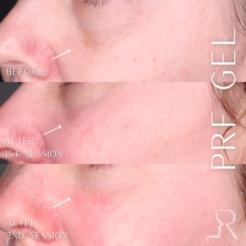 PRF Skin Before & After Image