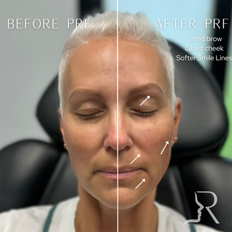 PRF Skin Rejuvenation Before & After Image