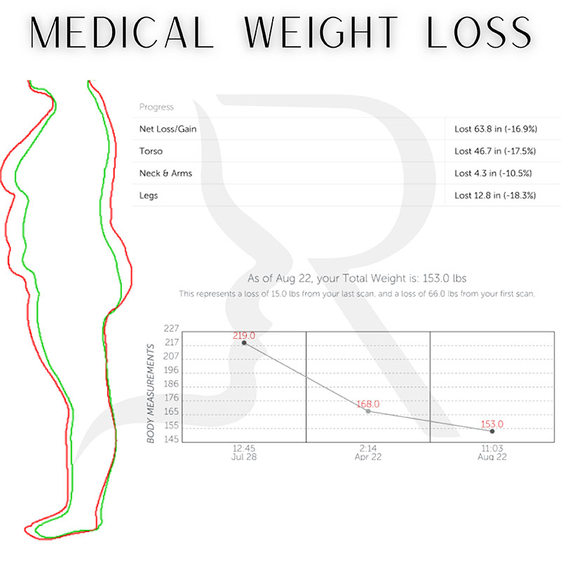 Medical Weight Loss Before & After Image